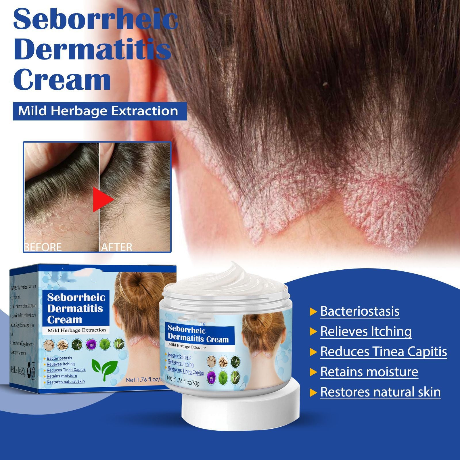       Seborrheic Skin Cream: Soothes Head Acne and Itch, Promotes Repair – BEAUTY NET