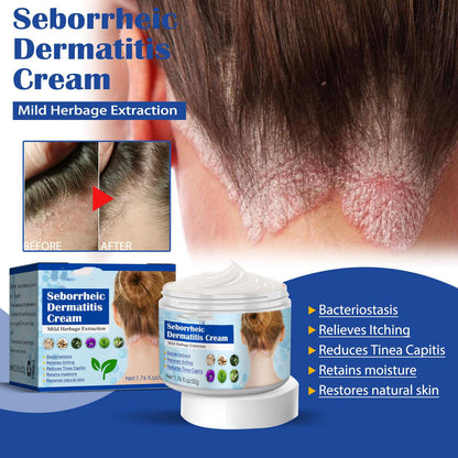 Seborrheic Skin Cream: Soothes Head Acne and Itch, Promotes Repair