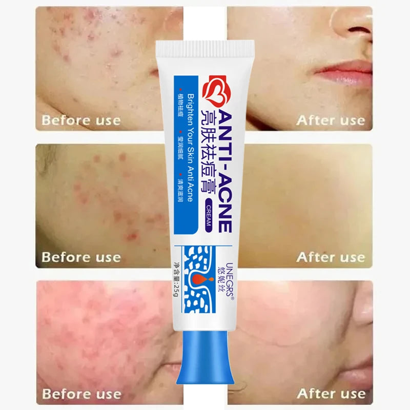 Salicylic Acid Acne Treatment Cream – Deep Cleaning Pore Repair, Oil Control, and Pimple Spot Shrinking Moisturizer