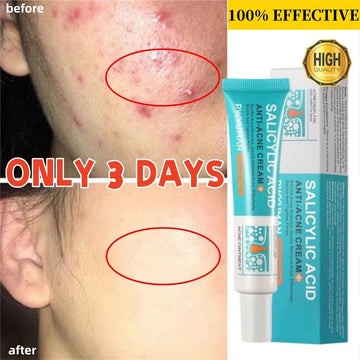 Salicylic Acid Acne Treatment Cream – Anti-Acne & Pimple Scar Repair Gel, Shrink Pores, Moisturizing & Smoothing Skin Care