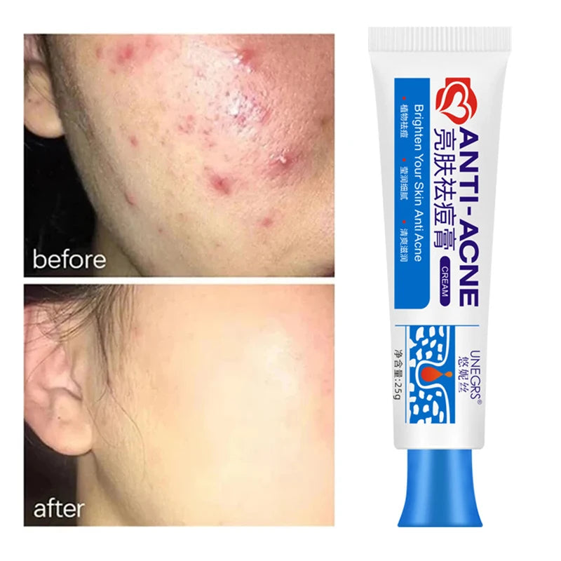 Salicylic Acid Acne Treatment Cream – Deep Cleaning Pore Repair, Oil Control, and Pimple Spot Shrinking Moisturizer