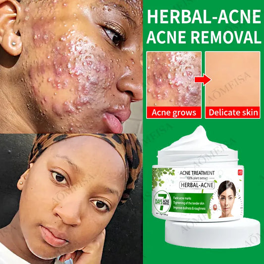 Herbal Essence Acne Cream: Anti-inflammatory, Anti-acne, Oil Control – Suitable for All Types of Acne.